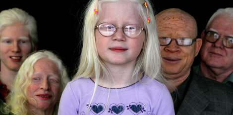 albinos-ojos1 albinos-ojos1